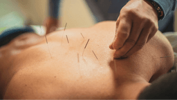 Image for Acupuncture Treatment